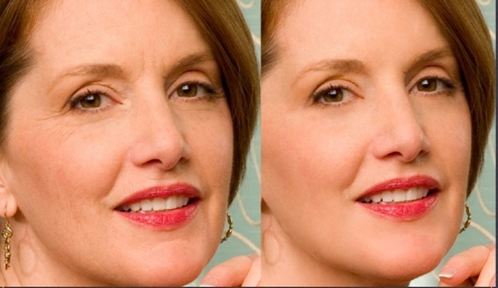 facial lifting