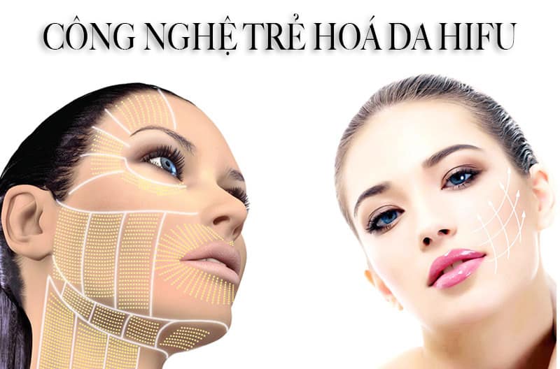 HIFU face-lifting technology method