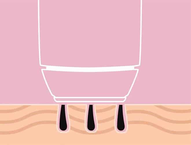 IPL hair removal technology